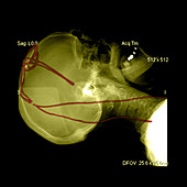 Lateral X-ray of Deep Electrodes