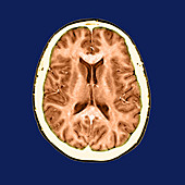 Normal Cross Sectional MRI of the Brain