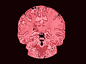 Coronal View MRI of Normal Brain
