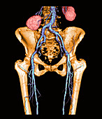 Pelvis and Upper legs with Arterioscleros