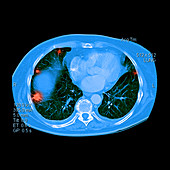 Metastatic Disease of the Lungs