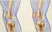 Comparing Normal Knee and Jumper's Knee