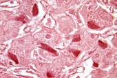Human Liver Infected with Hepatitis B (LM