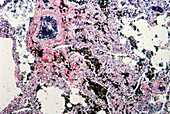 Carbon Deposits in Lung Tissue