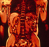 MRI of Human Abdomen