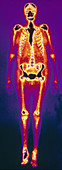 Osteomyelitis