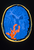MRI of Glioblastoma Multiforme