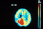 PET Brain Scan,Malignant Tumor