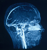 MRI Angiography