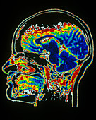 Human Head,MRI