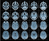 Axial Brain MRI