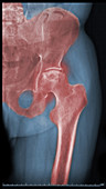Osteoarthritis,Hip