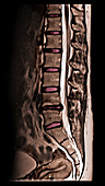 Herniated Disc,MRI