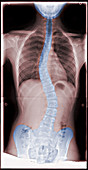 Scoliosis,X-Ray