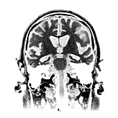 MRI of Alzheimers Disease 2