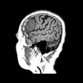 MRI of Frontal Meningioma