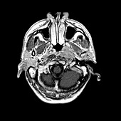 MRI of Nasopharyngeal Carcinoma
