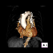 3D CT of Normal Heart
