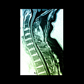 MR of Congenital Spinal Fusion