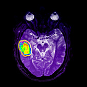 MRI of Temporal Lobe Hematoma