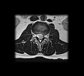 MRI of Lumbar Schwannoma