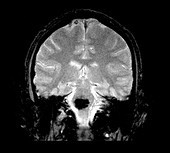 Cavernous Malformation,MRI