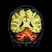 Cerebellar Atrophy,MRI