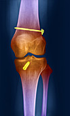 ACL Knee Repair X-Ray