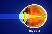 Myopia Diagram