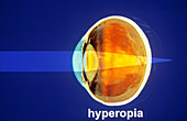 Hyperopia Diagram