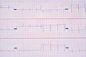 Atrial Flutter EKG