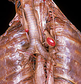Esophageal and Pulmonary Plexus
