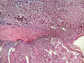 Kidney Carcinoma