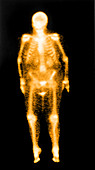 Nuclear Scintigraphy