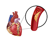 Thrombosis in Coronary Artery