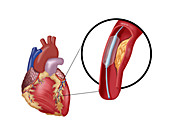 Balloon Angioplasty,2 of 4