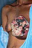 Fungating Malignant Breast Tumor