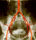 Normal Arteriogram