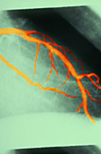 Narrowing in Coronary Artery (3 of 3)