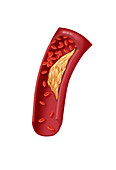 Atherosclerotic Coronary Artery Disease
