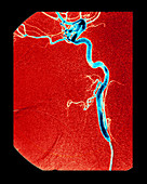 Internal Carotid Artery,Angiogram