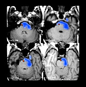 MRI of Epidermoid Lesion