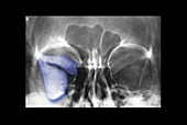 Fibrous Dysplasia of Skull,X-Ray