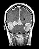 Multiple Meningiomas,MRI