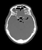 Post-Traumatic Pneumocephalus,CT