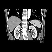 Kidneys & Scoliosis,CT