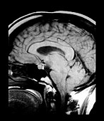 Spontaneous Intracranial Hypotension,MRI