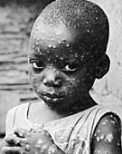 Child With Smallpox