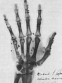 X-ray of Gunshot in the Hand