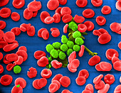 Lymphocytic Leukemia,SEM